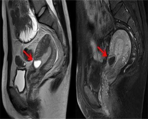 有好的代孕公司吗,慢性输卵管炎的发病原因,慢性输卵管炎的症状